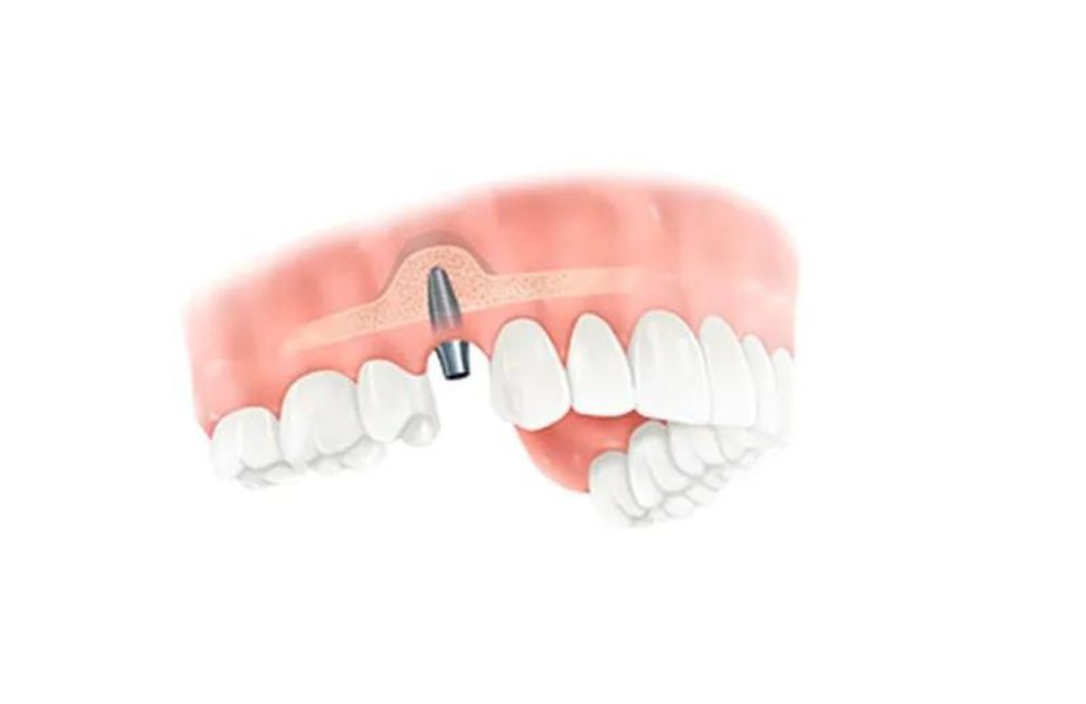 implantes-con-poco-hueso-chamberi-madrid