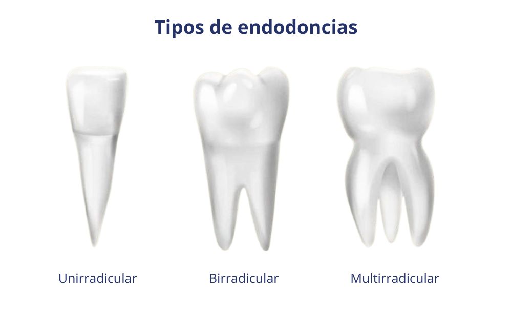 tipos-de-endodoncia