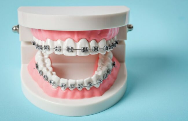 Ortodoncia con brackets