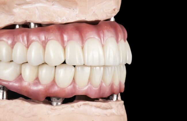 Implantes All-on-4