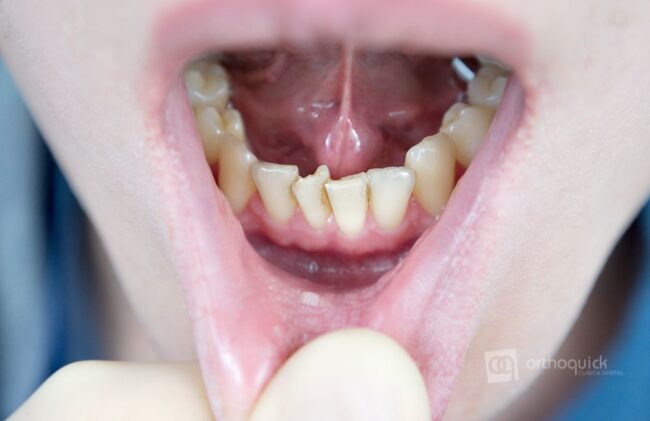 Dientes torcidos y sucios Boca con dientes torcidos y sarro