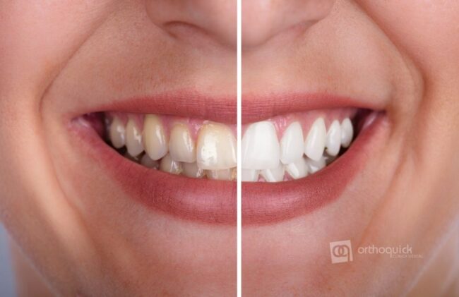 orthoquick-blanqueamiento-dental