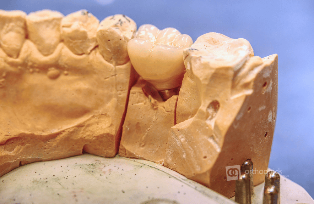 prótesis dentales