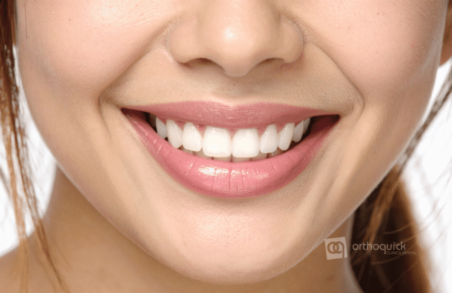 sonrisa gingival