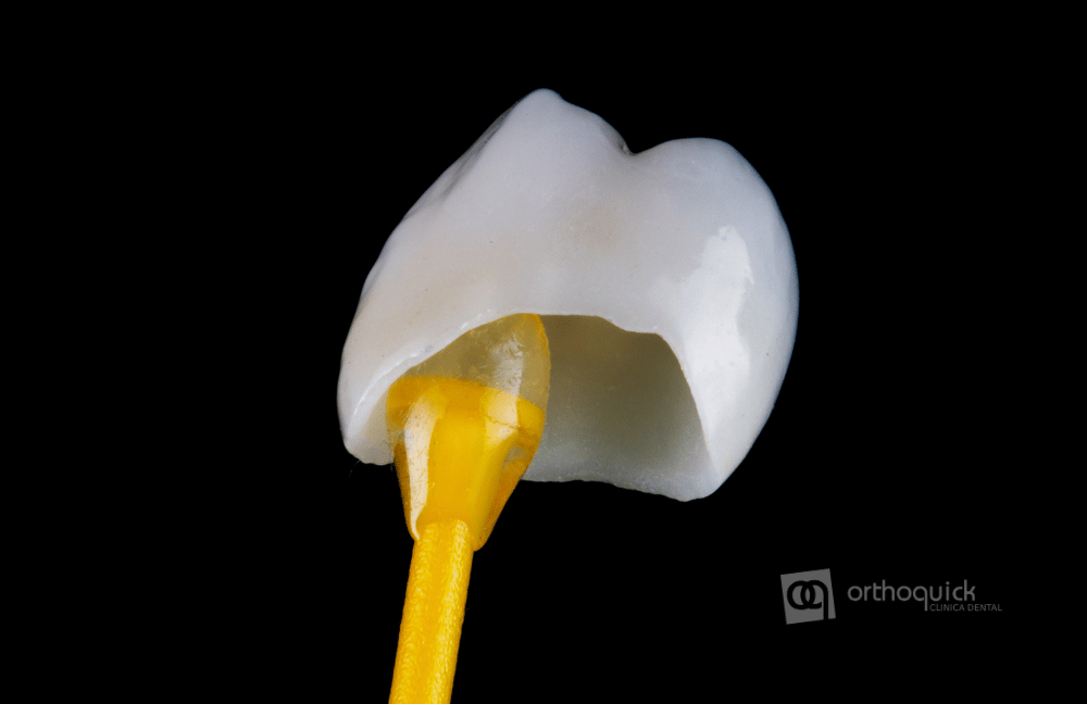 Tipos de coronas dentales