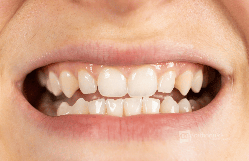 Corrige las maloclusiones con ortodoncia invisible
