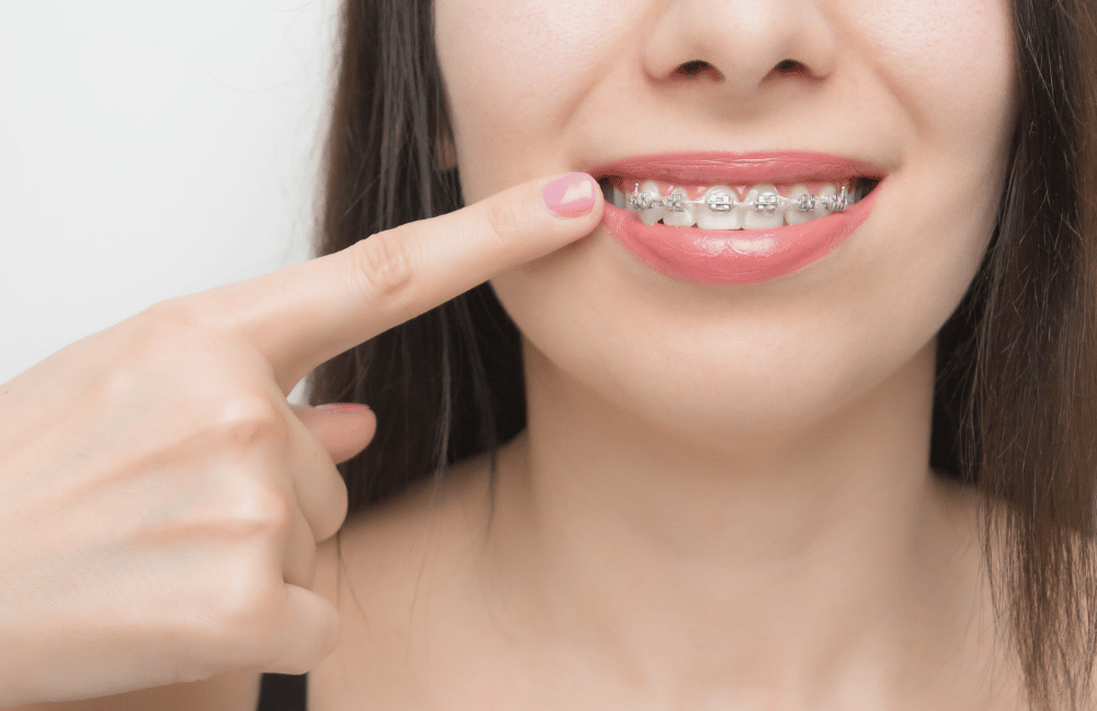 brackets autoligables