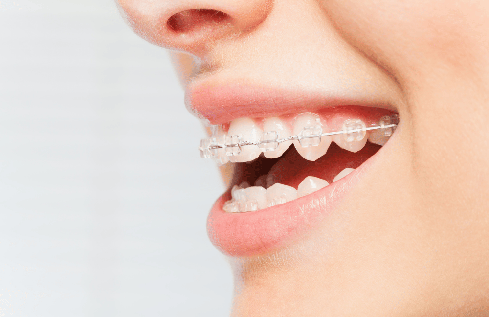 brackets estéticos