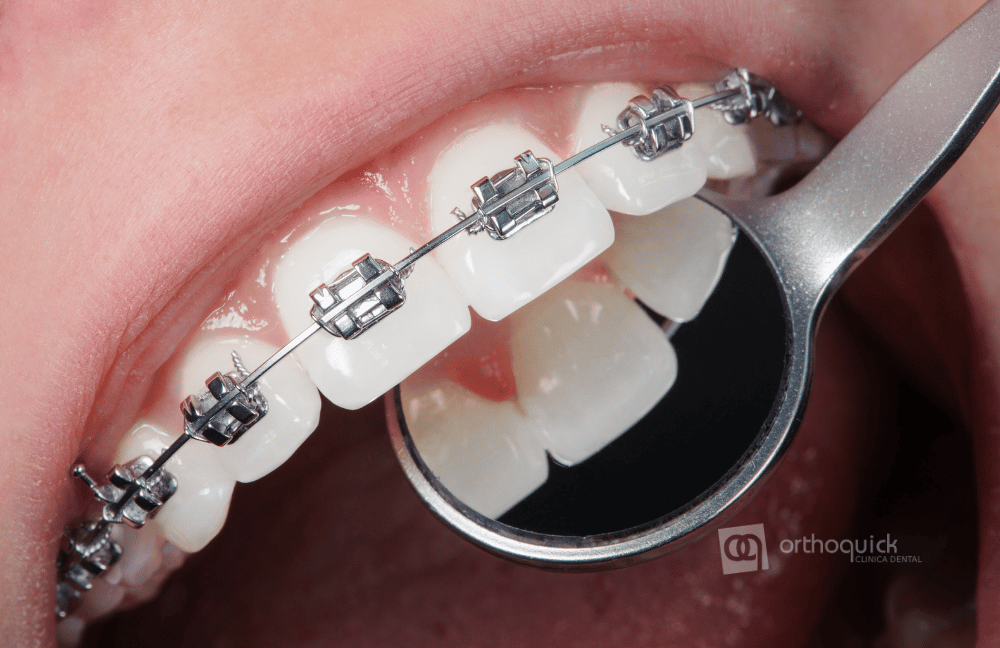 brackets metalicos