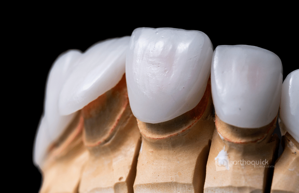 carillas de porcelana